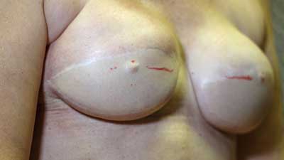 3D areola treatment