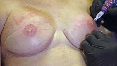 3D areola nipple reconsruction