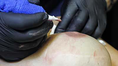 3D areola nipple reconsruction