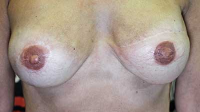 3D areola nipple reconsruction